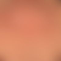 Feldkanzerisierung: flächig hyperpigmentierte Haut mit multiplen&nbsp;aktinischen Keratosen. Größ...