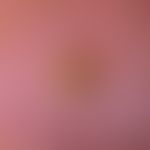 Keratosis actinica: klinisches Bild des Cornu cutaneums.&nbsp;
