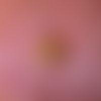Keratosis actinica: klinisches Bild des Cornu cutaneums.&nbsp;
