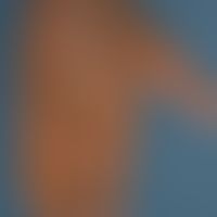 Eczema atopic (in dark skin): here as partial manifestation of a generalized (face, neck, hands, ...