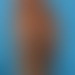 Eczema atopic (in dark skin): here as partial manifestation of a generalized (face, neck, hands, ...