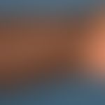 Eczema atopic: Skin lesions in a 22-year-old woman with generalized atopic eczema. In the area of...