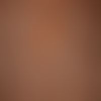 Generalized atopic eczema: large-area, chronic. generalized seizure-like itchy dermatitis with mu...
