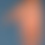 Eczema atopic (overview): only slight eczematous infestation of the palms in generalized atopic e...