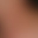 Schwangerschaftsdermatose polymorphe:&nbsp;stark juckendes Exanthem mit urtikarielle Papeln und P...