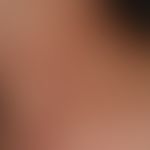 Pregnancy dermatosis polymorphic: very itchy exanthema with urticarial papules and plaques, last ...