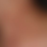 Schwangerschaftsdermatose polymorphe:&nbsp;stark juckendes Exanthem mit urtikarielle Papeln und P...