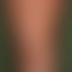 Pregnancy dermatosis polymorphic: very itchy exanthema with urticarial papules and plaques, last ...