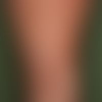 Schwangerschaftsdermatose polymorphe:&nbsp;stark juckendes Exanthem mit urtikarielle Papeln und P...