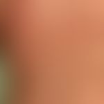 Pregnancy dermatosis polymorphic: very itchy exanthema with urticarial papules and plaques, last ...