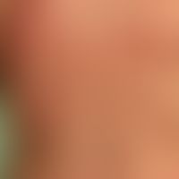 Schwangerschaftsdermatose polymorphe:&nbsp;stark juckendes Exanthem mit urtikarielle Papeln und P...