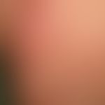 Pregnancy dermatosis polymorphic: very itchy exanthema with urticarial papules and large plaques,...