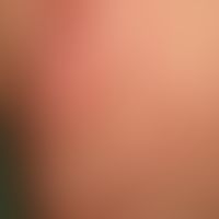 Schwangerschaftsdermatose polymorphe:&nbsp;stark juckendes Exanthem mit urtikarielle Papeln und g...