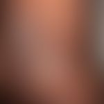 Mycosis fungoides: Plaque stage. 52-year-old man with multiple, disseminated, 1.0-5.0 cm large, i...