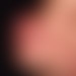 Keratoakanthoma, classictype. short term, within 6-8 weeks grown, approx. 2.5 cm diameter, hard, ...