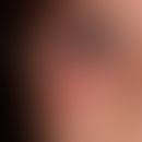 Atopic eczema in children/adolescents: 3-year-old toddler with previously known atopic eczema; fo...