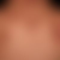 Atopiceczema in children/adolescents: 3-year-old toddler with previously known atopic eczema; for...