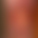 Ulcus cruris mixtum: hochschmerzhaftes,&nbsp;chronisch dynamisches, unscharf begrenztes, flaches,...