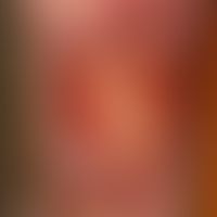 Ulcus cruris mixtum: highly painful, chronically dynamic, blurred, flat, smeary-coated, yellow-re...
