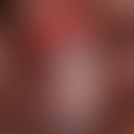 Balanitis erosiva circinata: pronounced, multicenter, sharply defined, bright red, arched, weepin...