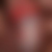 Balanitis erosiva circinata: ausgeprägte, multizentrische, scharf begrenzte, hochrote, bogig begr...