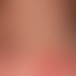 Dermatomyositis adult: acutely occurring, blurred and bizarrely limited, large-area, red to red-v...