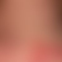 Dermatomyositis adult: acutely occurring, blurred and bizarrely limited, large-area, red to red-v...