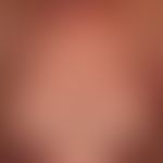 Dermatomyositis adult: acutely occurring, blurred and bizarrely limited, large-area, red to red-v...