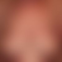 Dermatomyositis adult: acutely occurring, blurred and bizarrely limited, large-area, red to red-v...