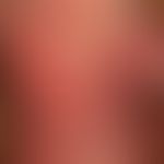 Dermatomyositis adult: acutely occurring, blurred and bizarrely limited, large-area, red to red-l...
