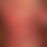 Dermatomyositis adult: acutely occurring, blurred and bizarrely limited, large-area, red to red-l...