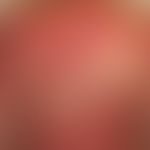 Dermatomyositis adult: acutely occurring, blurred and bizarrely limited, large-area, red to red-l...