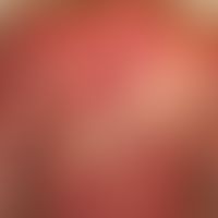 Dermatomyositis adult: acutely occurring, blurred and bizarrely limited, large-area, red to red-l...