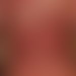 Dermatomyositis adulte:&nbsp;akut aufgetretene, unscharf und bizarr begrenzte, großflächige, rote...