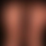 Lichen planus pigmentosus: brownish, elongated to oval, shiny plaques, as partial manifestation o...