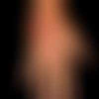 Leishmaniasis, cutaneous: about 8 weeks old, furuncoloid, moderately pressure dolent, red, rough ...