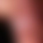 Leukoplakie orale: verruköse retroanguläre Leukoplakie ungeklärter Ätiologie. Histologisch: Präka...
