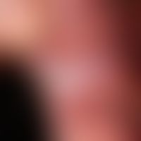 Leukoplakie orale: verruköse retroanguläre Leukoplakie ungeklärter Ätiologie. Histologisch: Präka...