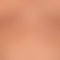 Lichen sclerosus extragenitaler: a progressive, completely asymptomatic clinical picture with dis...