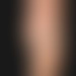 Malformation, venöse:&nbsp;venöse Malformation mit umschriebener, schmerzloser Weichteilschwellun...