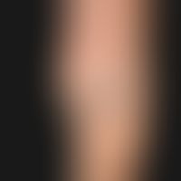 Malformation, vascular: venousmalformation with circumscribed, painless soft tissue swelling (cir...