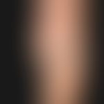Malformation, vaskuläre:&nbsp;venöse Malformation mit umschriebener, schmerzloser Weichteilschwel...