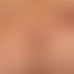 Type I Neurofibromatosis, peripheral type or classic cutaneous form. Since puberty slowly increas...