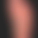 Pustulosis palmaris et plantaris:&nbsp;seit Monaten rezidivierendes Krankheitsbild mit "dyshidrot...