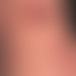 Ekthyma (Detailaufnahme): multiple, an beiden Unterarmen und &nbsp;Handrücken &nbsp;akut aufgetre...