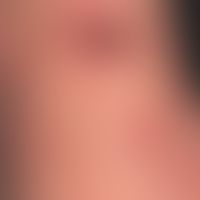 Ekthyma (Detailaufnahme): multiple, an beiden Unterarmen und &nbsp;Handrücken &nbsp;akut aufgetre...