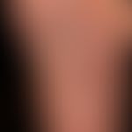 Palmar and plantar filids: disseminated, reddish-brown, scaly papules on palms and soles; no itch...