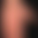 Palmar- und Plantarsyphilide:&nbsp;disseminierte, rot-braune, schuppende Papeln and Handflächen u...