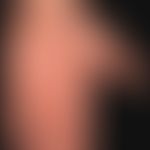 Palmar and plantar filids: disseminated, reddish-brown, scaly papules on palms and soles; no itch...