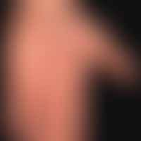Palmar and plantar filids: disseminated, reddish-brown, scaly papules on palms and soles; no itch...